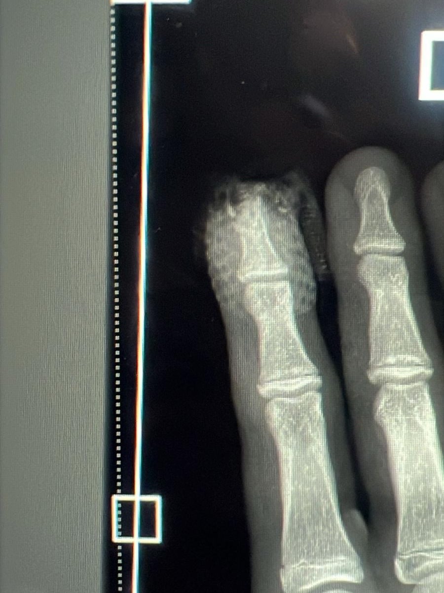 Ryon Land Xray of Hand